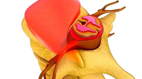 thoracic spine osteochondrosis The essence of the disease