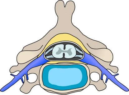 Protabius in the vertebra with cervical osteochondrosis