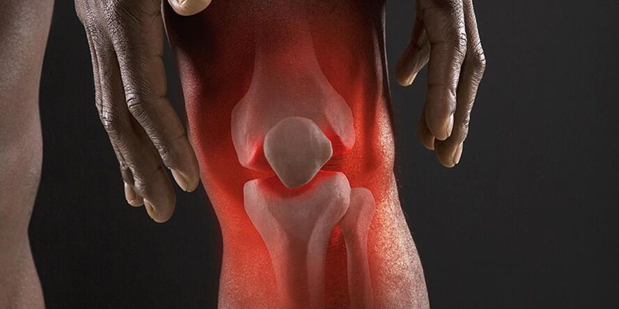 Burning sensation in the knee region is a symptom of gonarthrosis